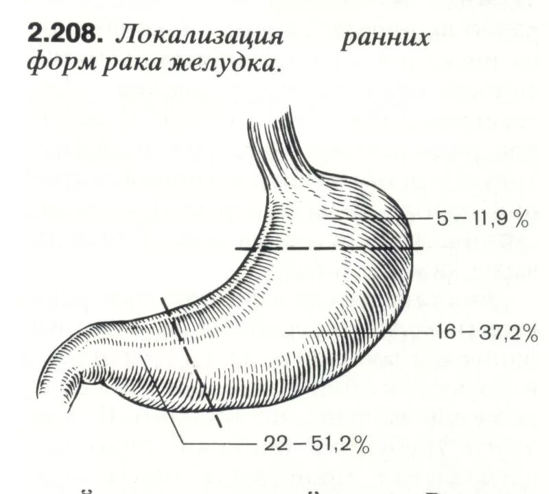 Как определить стадию рака желудка. Наиболее частая локализация карциномы желудка. Частая докализация оакажелудка. Локализация карциномы желудка.