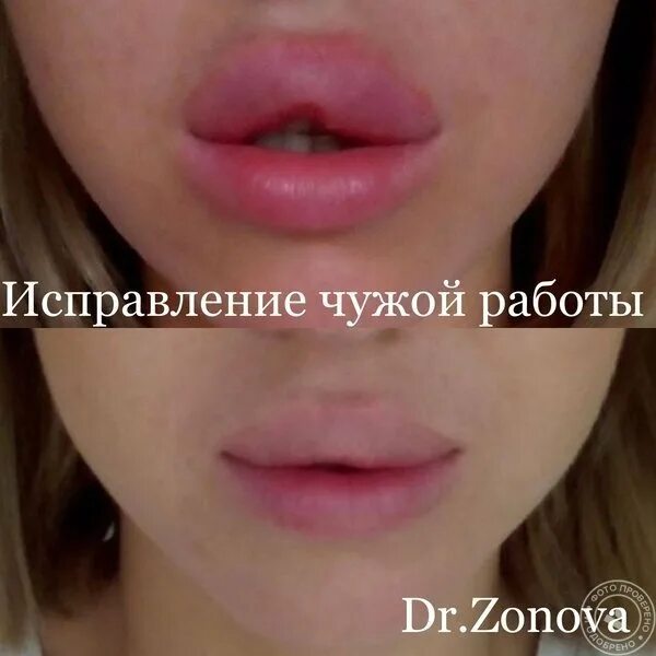 Картинки НАКАЧАТЬ ВЕРХНЮЮ ГУБУ