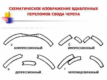 Импрессионный перелом кости