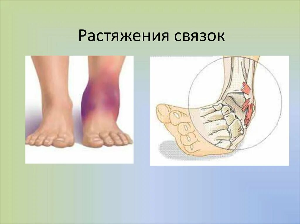 Растяжение связок голеностопа. Растяжение связок голеностопа это травма. Растяжение связок голеностопа степени растяжения. Вивих связки голеностоп.