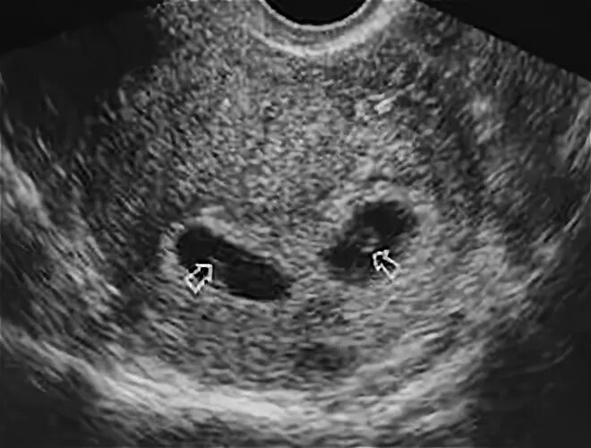 Подсаживали 2 эмбриона. 5 Дневный эмбрион на УЗИ. 2 Недели после переноса эмбриона.