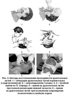 Методы восстановления проходимости дыхательных путей