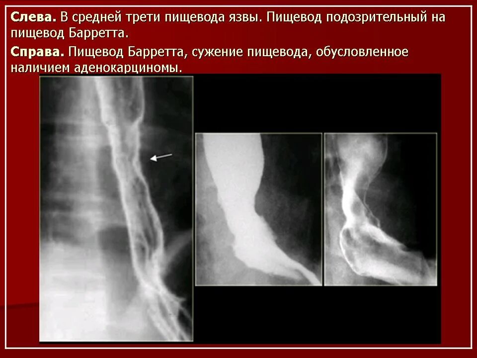 Пищевод баретта. Пищевод бареттарентген. Пищевод Барретта рентген пищевода. Пищевод Барретта рентгеноскопия.