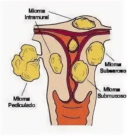 Миома сантиметр