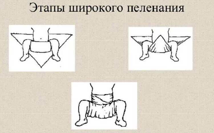 Пеленание при дисплазии. Широкое пеленание новорожденного при дисплазии. Широкое пеленание при дисплазии тазобедренных. Техника широкого пеленания при дисплазии тазобедренных суставов. Широкое пеленание при дисплазии тазобедренных суставов.