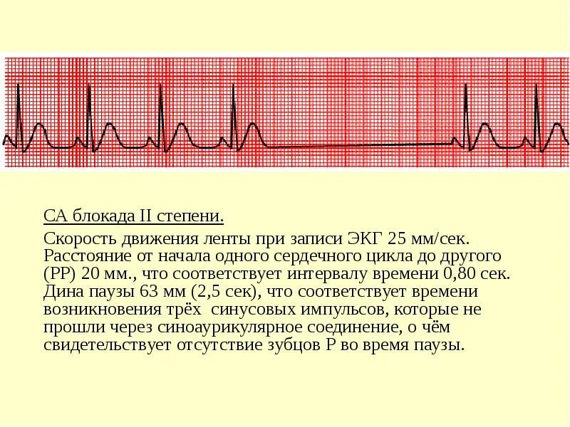 Синоаурикулярная блокада. Синоатриальная блокада Мобитц 1 ЭКГ. Са блокада 2 степени Мобитц 1 на ЭКГ. Синоатриальная блокада 2 степени на ЭКГ. АВ блокада 2 степени Мобитц 1 на ЭКГ.