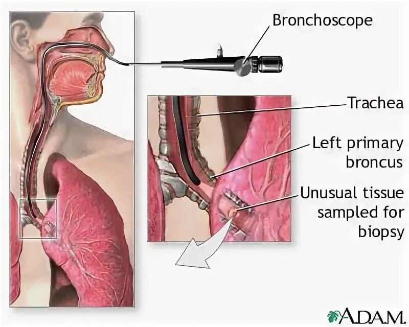 Биопсия легких как проводится. Бронхоскопия и бронхография. Ригидная бронхоскопия. Бронхоскопическая биопсия.