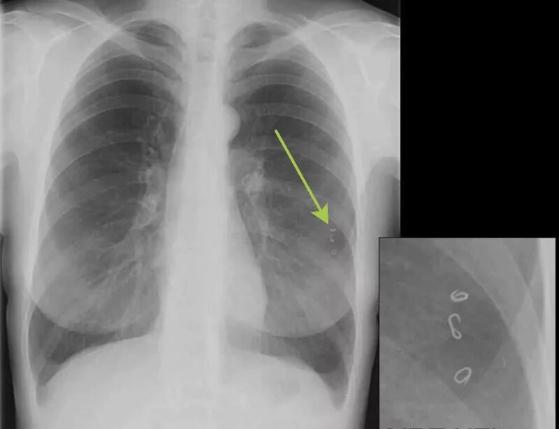 аскариды в легких на рентгене. Strongyloides stercoralis. аскариды в легких на рентгене. эхинококкоз печени макропрепарат. эозинофильная пневмония рентген.