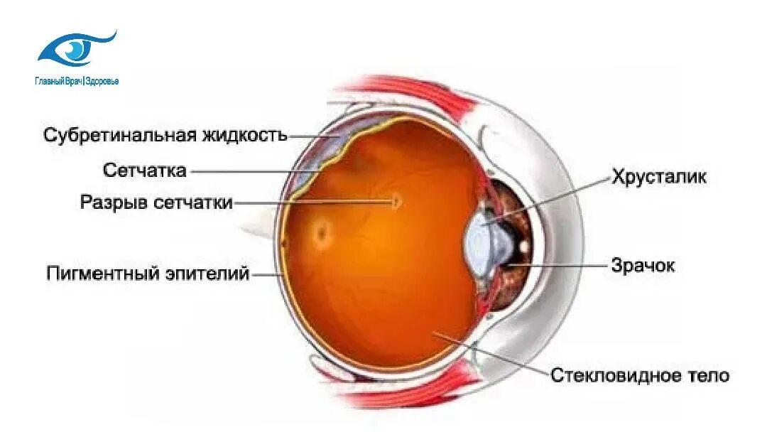 Разрыв сетчатки (retinal tear). Жидкость в сетчатке