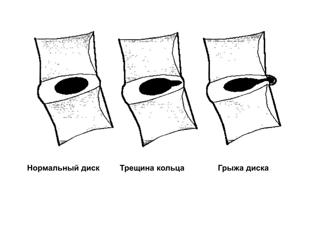 Сон трещина. Грыжи дисков классификация. Трещинообразование кольца. Грыжа на колесе. Трещина на члена от кольца.