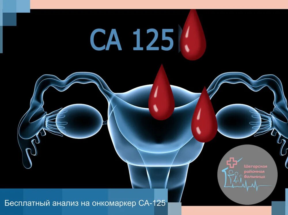 Са 125. Са-125 онкомаркер. Маркер са 125. Онкомаркеры 125. Онкомаркер са 125 при кисте яичника