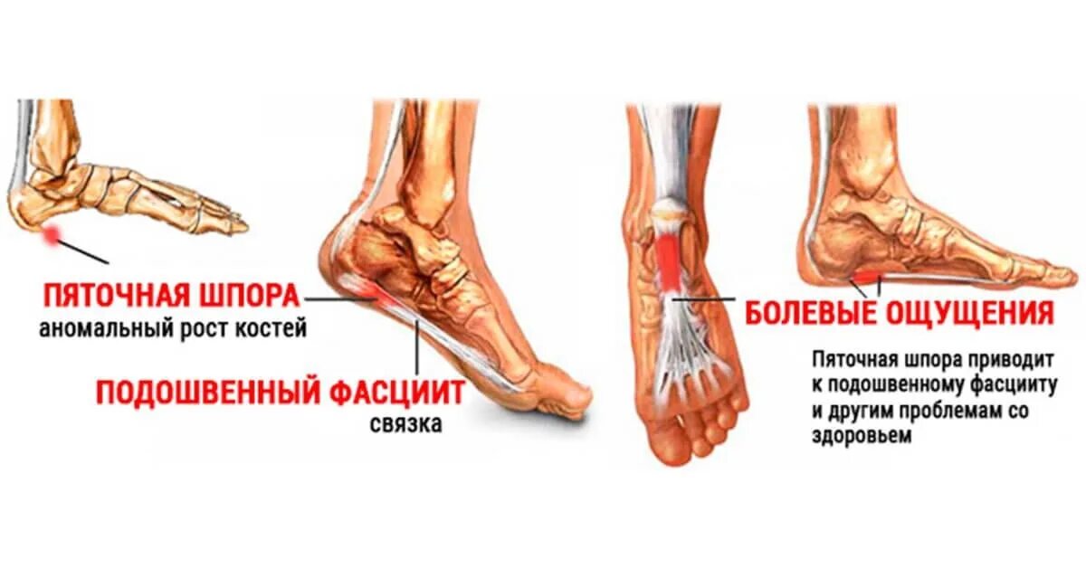 Шпора на пятке симптомы у мужчин. Подошвенный (плантарный) фасциит клиника. Пяточная шпора плантарный фасциит. Ахиллова пяточная шпора. Пяточная шпора подошвенный фасцит.