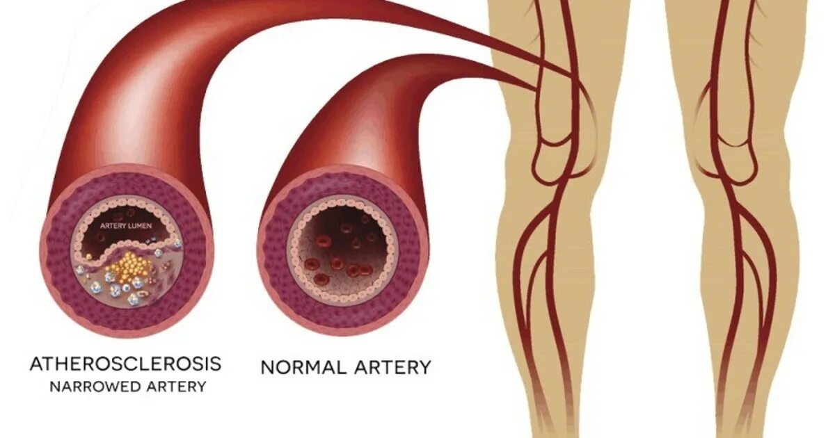 Атеросклеротическое поражение нижних конечностей