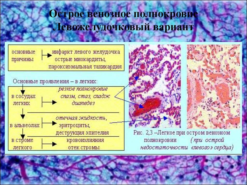 Острая и хроническая венозная гиперемия. Хроническое венозное полнокровие печени микропрепарат. Хроническое венозное полнокровие печени патанатомия. Хроническая венозная гиперемия. Хроническое венозное полнокровие печени микропрепарат.
