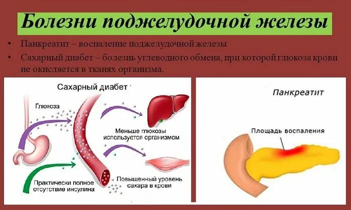 Панкреатит действие. Поджелудочная железа при сахарном диабете 2. Сахарный диабет 2 поджелудочная железа. Панкреатит сахарный диабет. Панкреатогенный сахарный диабет.