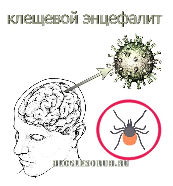 Энцефалит мозга у взрослых. Клещевой вирусный энцефалит. Клещевой вирусный энцефалит клиника. Клещевой вирусный энцефалит лихорадочная форма. Энцефалитьнервной системы.