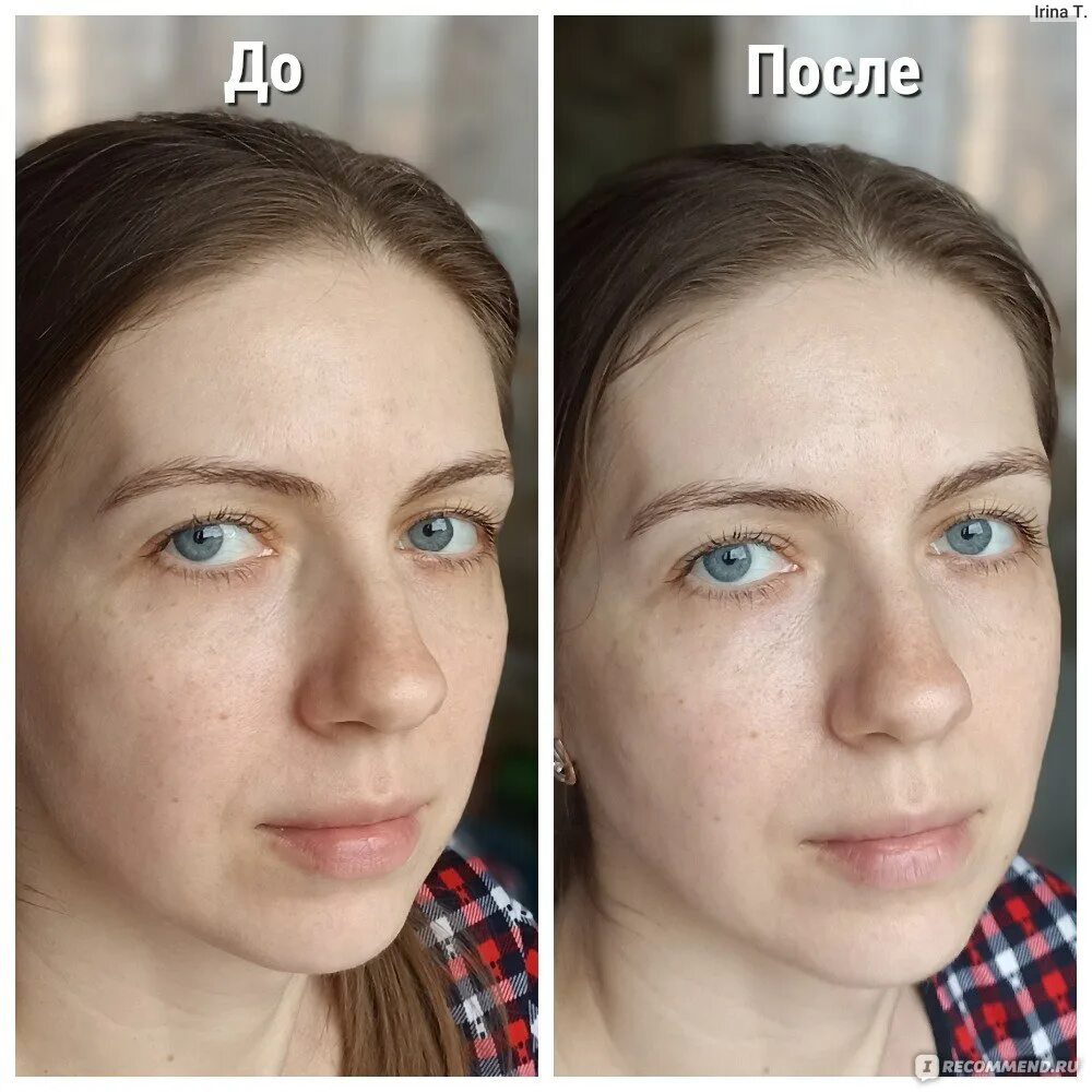 Мезовартон для лица. отзывы, последствия, фото до и после, процедура в косметоло