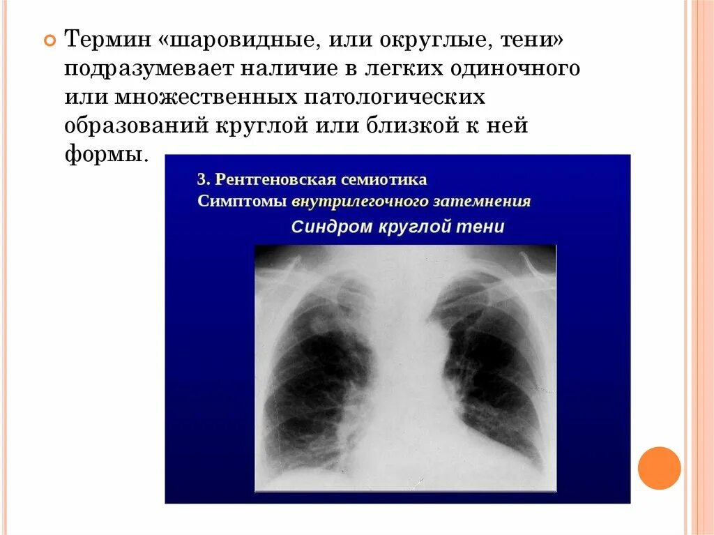 Округлыми формами в легком. Шаровидная тень в легких. Округлая тень в легком. Шаровидные образования в легких.