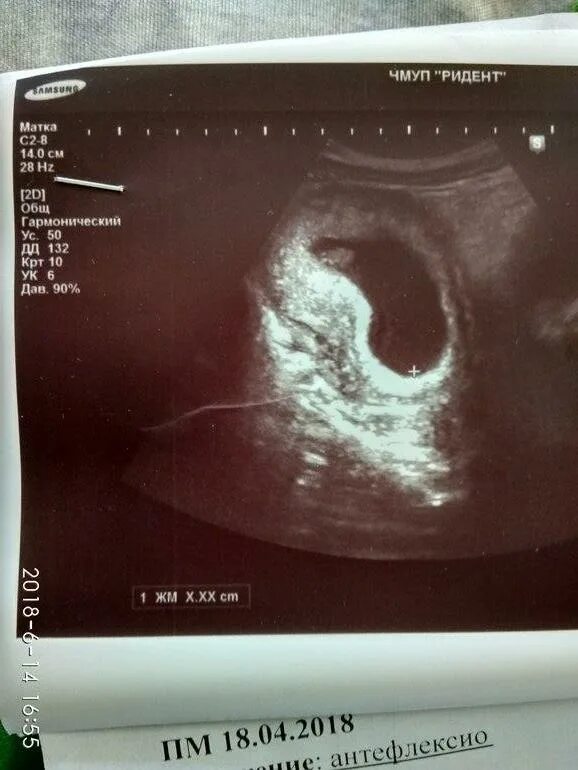 2 недели акушерской беременности