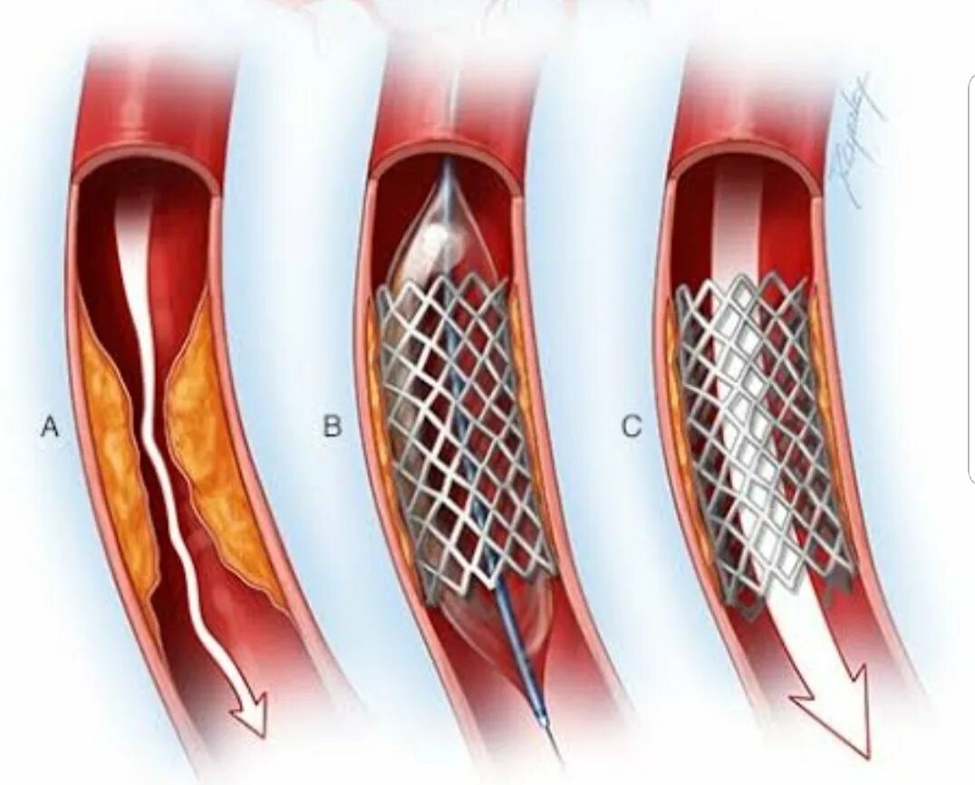 Болит стент. Операция при инфаркте миокарда стентирование. Инфаркт миокарда операция стент. Стентирование сердца при инфаркте миокарда. Коронарное стентирование сосудов сердца.