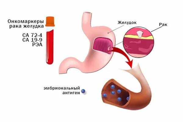 Опухолевые маркеры РЭА. Онкомаркер желудка. Онкомаркеры желудка. Са онкомаркер для желудка. Онкомаркер са72