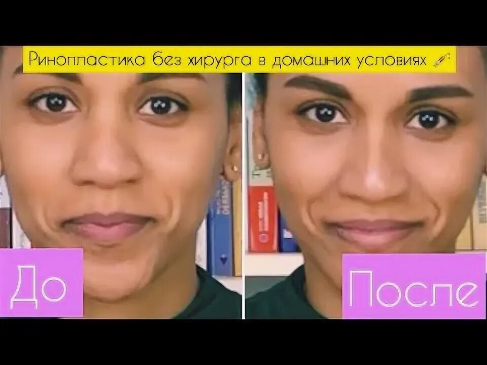 Филлеры и ботокс в чем разница. Коррекция носа ботулотоксином. ботокс и филлеры разница.