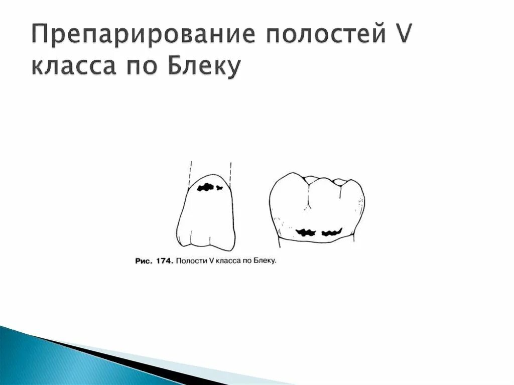 Препарирование это. Препарирование дефектов полостей 5 класса. препарирование класса по блеку. препарирование по классу по блеку. препарирование полостей v класса по блеку.