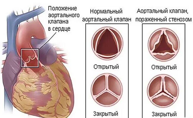 Аортальный стеноз что это такое