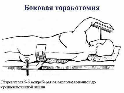 Торакотомия