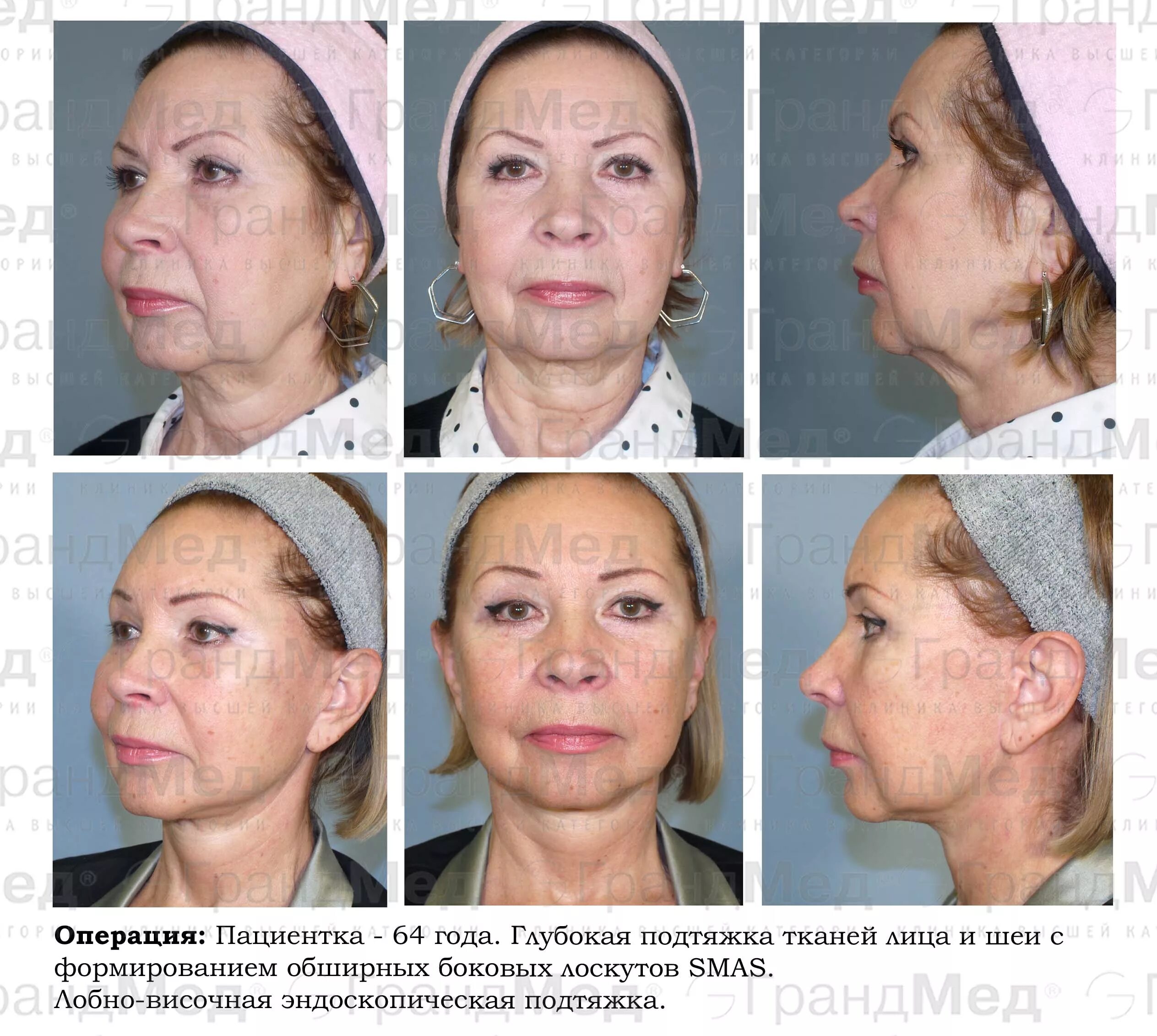 Плазмолифтинг (плазмотерапия). Плазмолифтинг для лица. Плазмолифтинг лица до и после. Плазменный лифтинг лица. Плазменная подтяжка