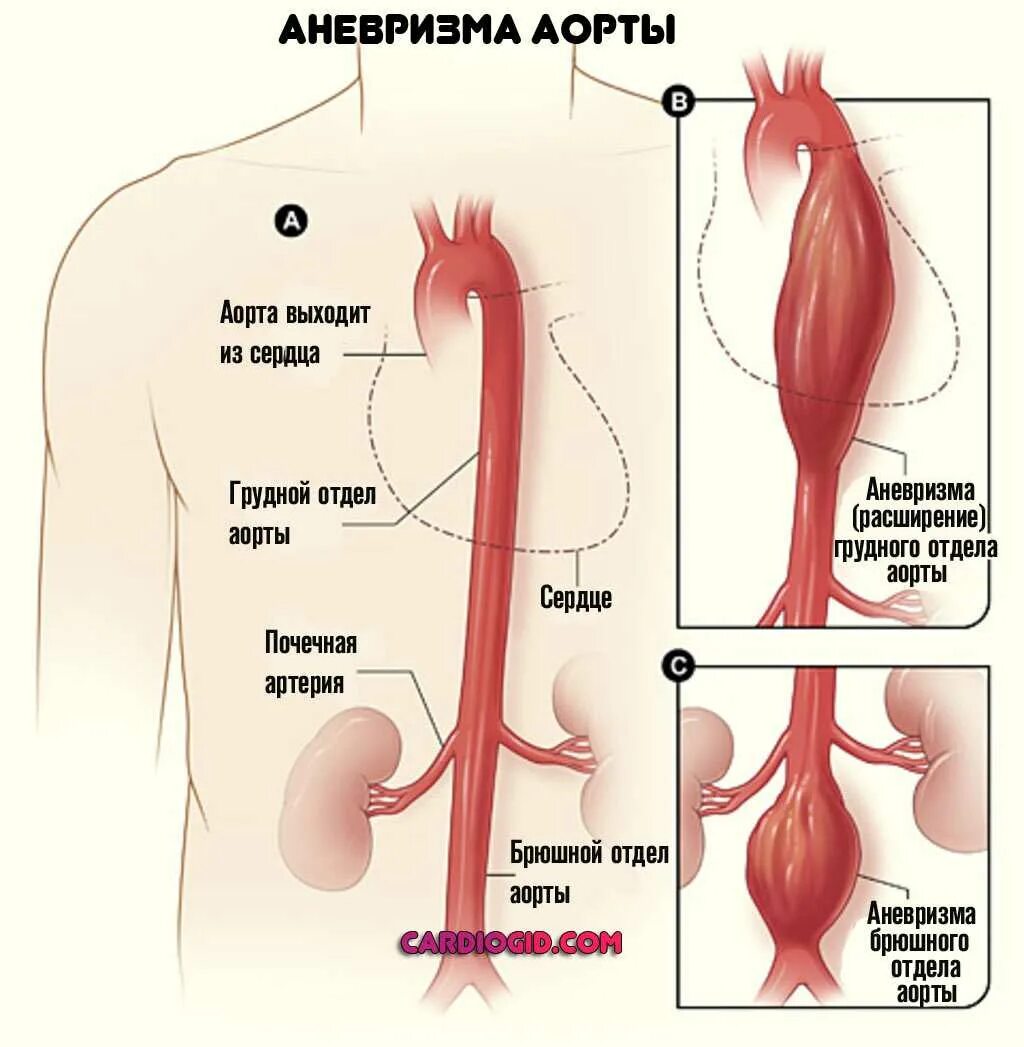 Аневризма торакального отдела аорты симптомы. Коронарные артерии венечные вены. Веретенообразная аневризма аорты. Кровоснабжение сердца. Строение сердца коронарные сосуды.