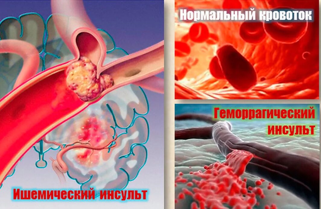 Инсульт картина. Инсульт. Инсульт геморогич ишемич. Ишемический инсульт картинки.