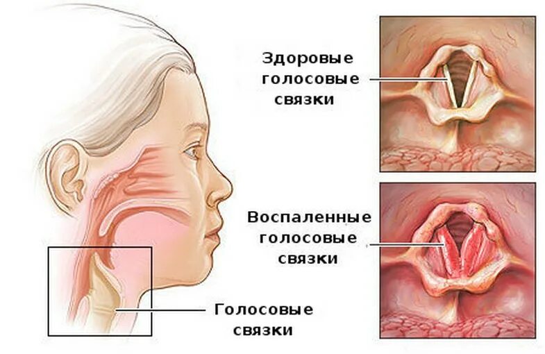 Ощущение горечи в горле. Инфильтративный ларингит. Острый катаральный ларингит. Подскладочный ларингит.