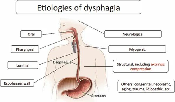 Ротоглоточная дисфагия. Причины дисфагии пищевода.
