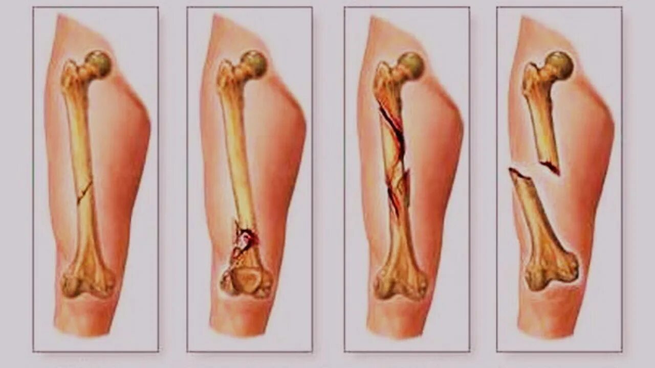 Как понять что у тебя трещина. Открытый перелом бедренной кости. Травматические переломы. Переломы костей закрытый открытый.