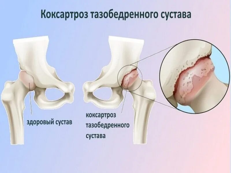 Коксо артроз бедренного сустава симптомы. Степени коксартроза тазобедренного сустава. Коксартроз тазобедренного сустава 2. Коксартроз тазобедренного сустава симптомы.