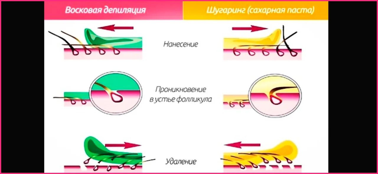 Направление роста волос. Схема нанесения воска. Воск против роста волос или по росту. Схема роста волос для шугаринга. Депиляция воском против роста или по росту