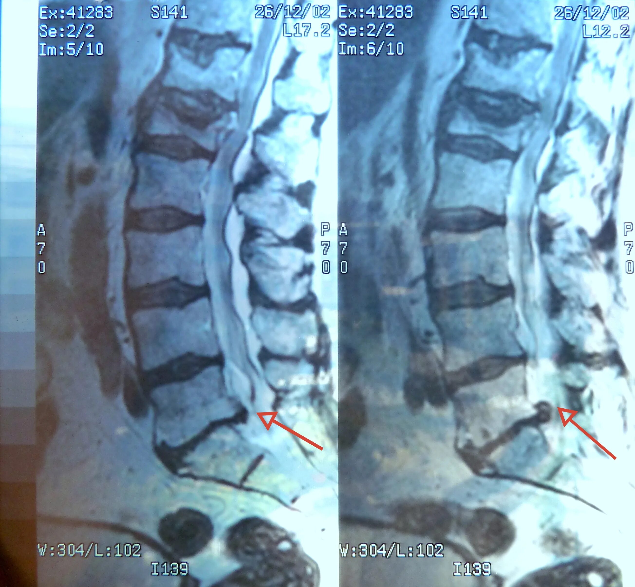 Радикулопатия l5 s1. Мрт позвоночника. Стеноз поясничного отдела мрт. Радикулопатия s1.