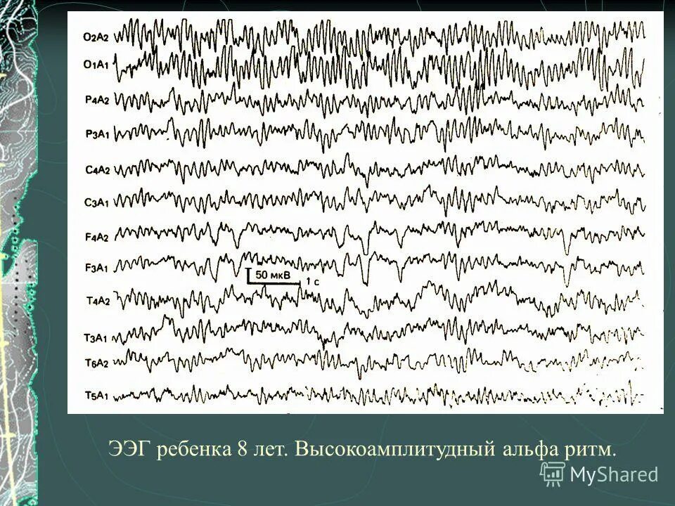 Низкоамплитудная ээг. Альфа ритм ЭЭГ. Высокоамплитудные Дельта волны на ЭЭГ. ЭЭГ У детей 6 лет Альфа ритм норма. Высокоамплитудная Дельта активность на ЭЭГ.