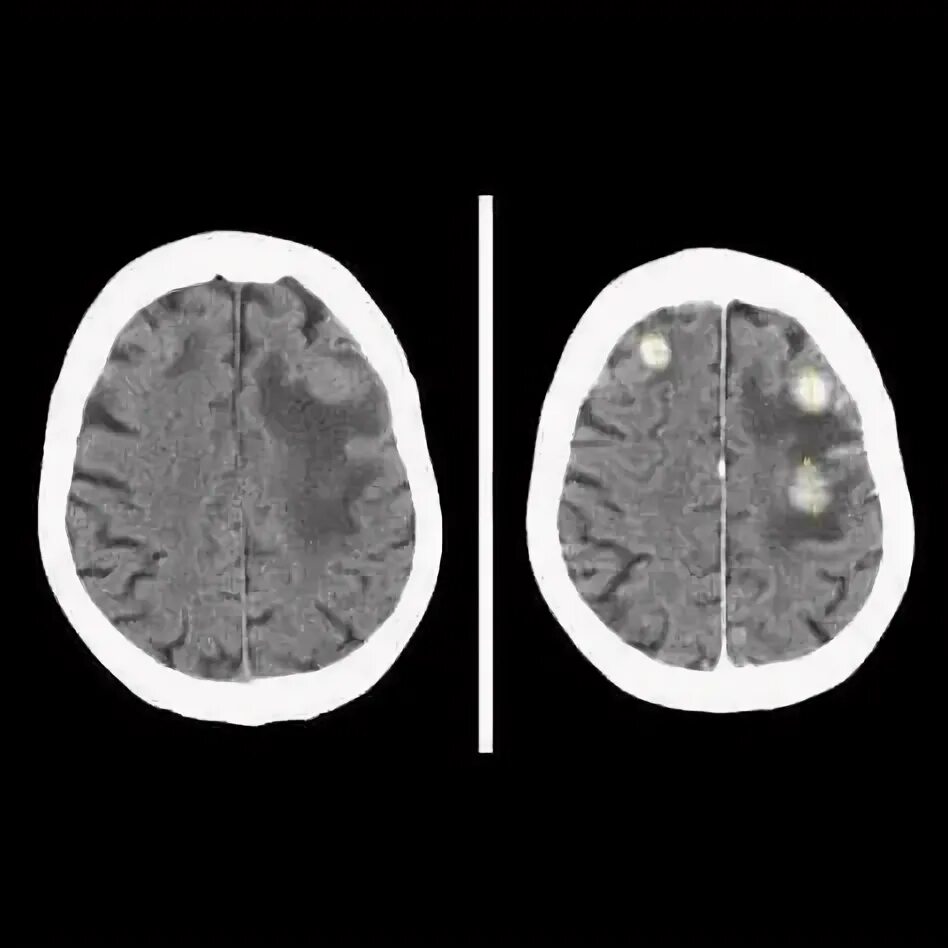 Меланома метастазы в мозг. Метастазы головного мозга кт. Метастазы головного мозга кт кт. Контузионные очаги на кт. Контузионные очаги головного мозга на кт.
