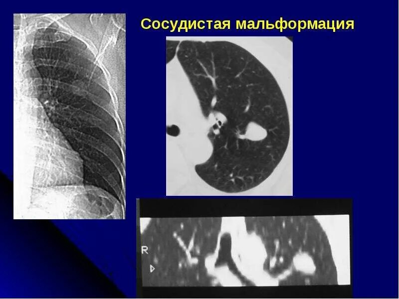 Авм легкого. Сосудистая мальформация легких на кт. Лимфоидная пневмония кт. Авм легкого. Мальформация сосудов легких кт.