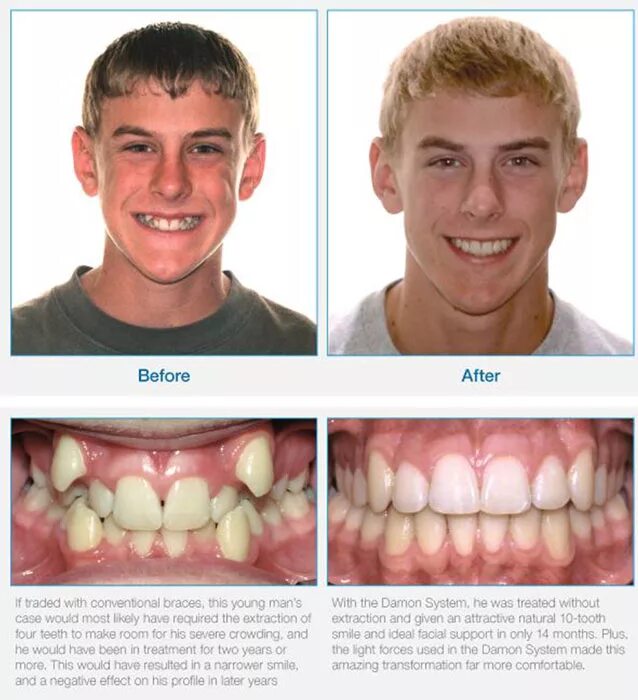 Мезиальный прикус брекеты. Дистальный прикус (прогнатический прикус). Исправление 23. Дистальный прикус и скученность. Глубокий прикус профиль.