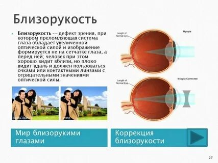 Миопия 1 ст