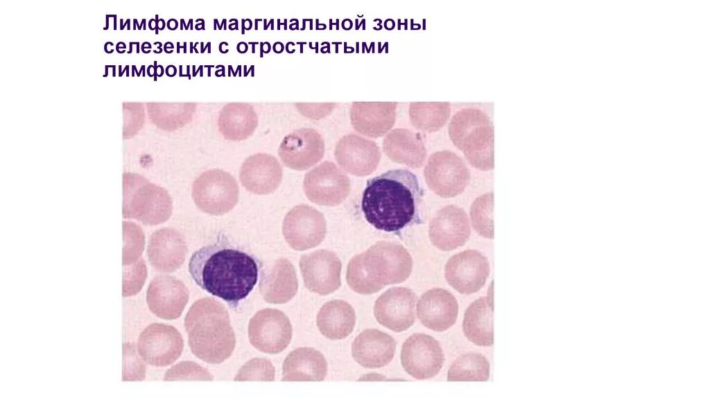 Лимфома малых лимфоцитов. Лимфома маргинальной зоны селезенки. Лимфома маргинальной зоны селезенки гистология.