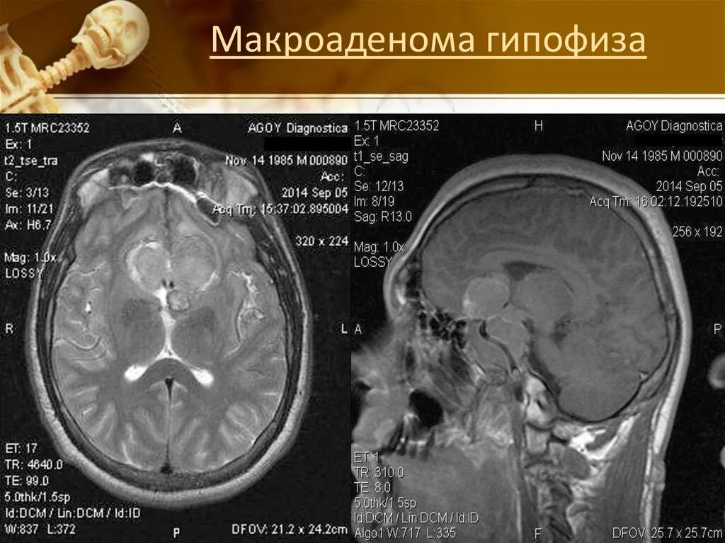 Макроаденома гипофиза