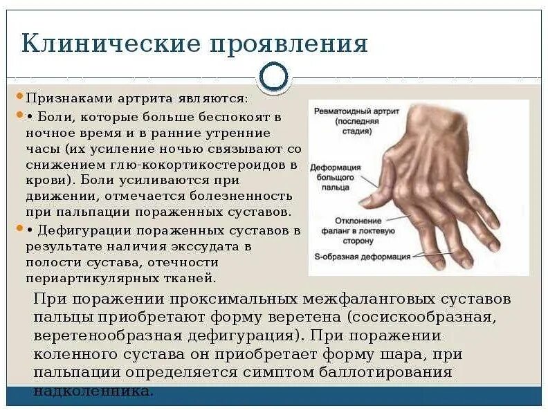 Синдромы остеоартрита