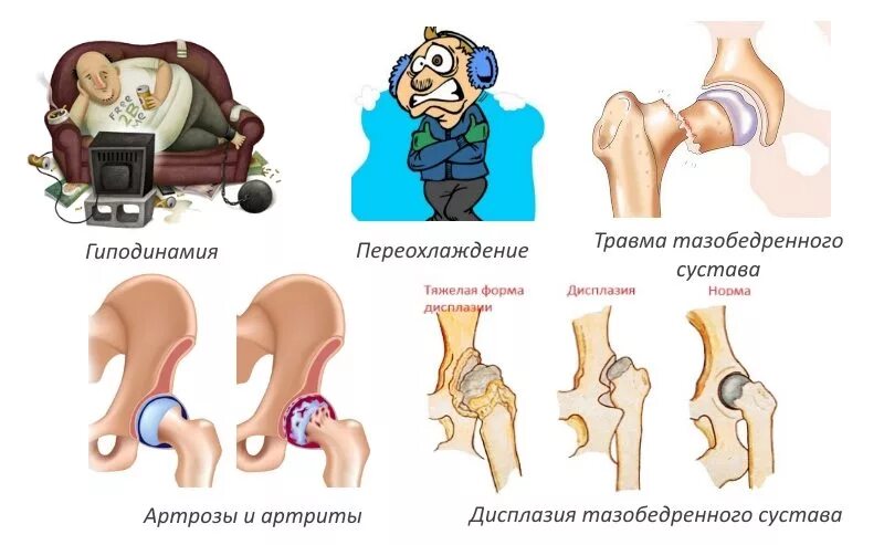 К какому врачу обращаться с тазобедренным суставом. Околосуставная сумка тазобедренного сустава. Вертельный бурсит тазобедренного. Бурсит синовиальной сумки тазобедренного сустава. Коксалгия тазобедренного сустава.