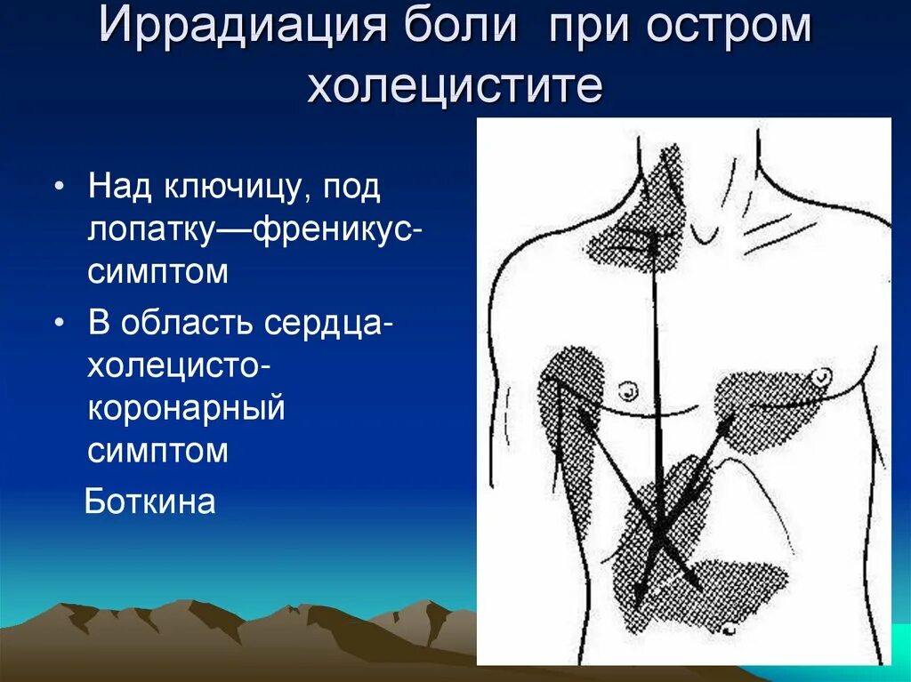 Иррадиация болей при остром холецистите. Локализация боли при остром холецистите. Иррадиация боли при хроническом холецистите. Иррадиация желчного пузыря. Иррадиация в левую лопатку