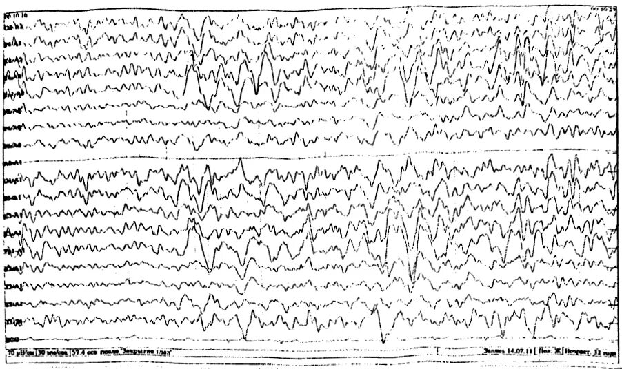 Диффузная активность ээг. ЭЭГ волны. Ханс Бергер электроэнцефалограмма. ЭЭГ при разных психических расстройствах. Судорожная готовность на ЭЭГ.