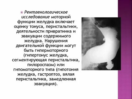 Достоверные клинические признаки стеноза привратника